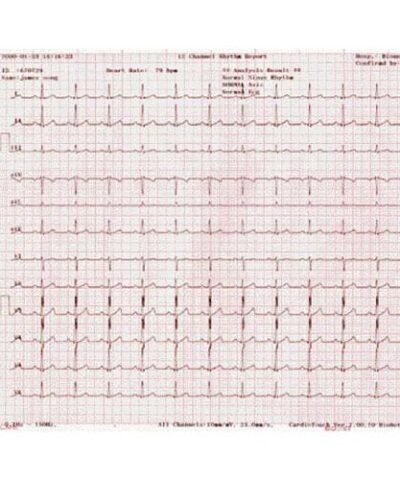 Telepaper Malaysia - ECG Paper Bionet Cardiocare 2000/3000 ( With Graph) (CSO)